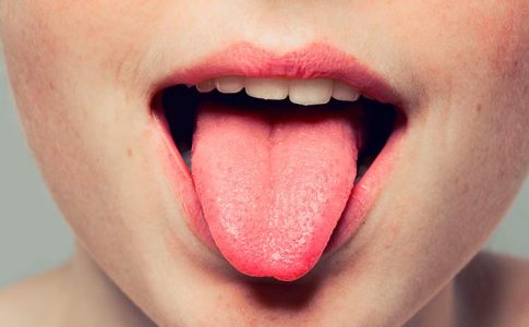remedios naturales para la lengua blanca