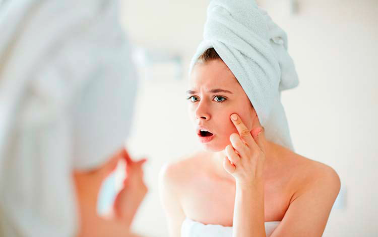 acne remedios caseros